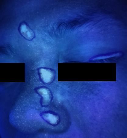 海口仁术白癜风.png