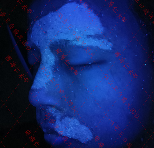 海口仁术白癜风.jpg
