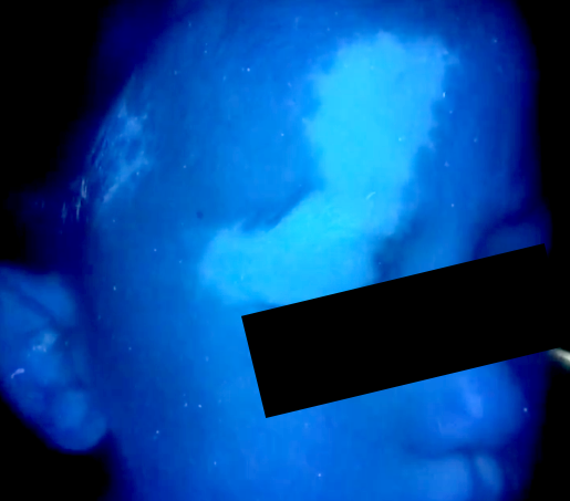 海口仁术白癜风.png