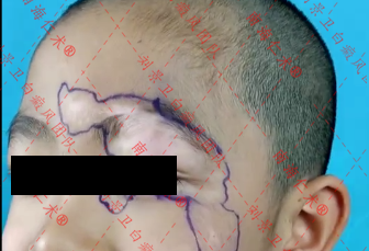 海口仁术白癜风.png