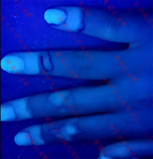 海口仁术白癜风.png