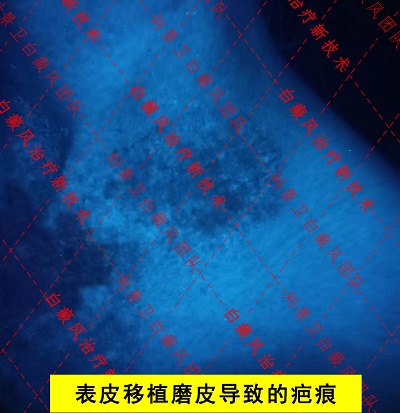表皮疤.jpg