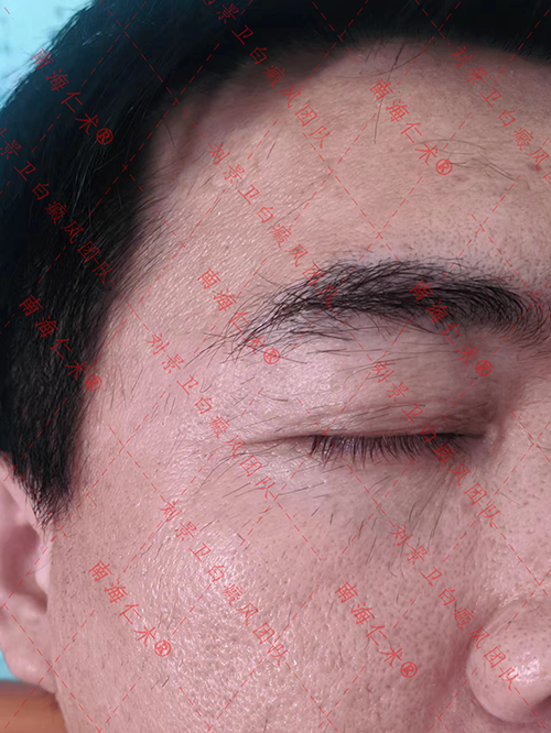 图片8.19由于现在白睫毛还不能治疗，着急就去把睫毛染黑了。.png