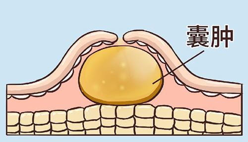 皮脂腺囊肿.jpg